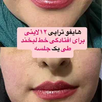 لیزر co2 فراکشنال و هایفوی پزشکی نه رومیزی|خدمات آرایشگری و زیبایی|اهواز, کیانپارس |دیوار
