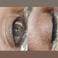 پلکسر مزو میکرونیلدینگ  رفع خال جوانسازی فیشیال|خدمات آرایشگری و زیبایی|مشهد, طلاب|دیوار