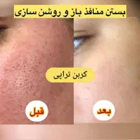 لیزر کیوسوئیچ رفع تیرگی صورت بیکینی و ریمو تاتو|خدمات آرایشگری و زیبایی|ارومیه, |دیوار