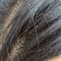توجه توجه، پاکسازی مو ها از شپش وتخم شپش بادستگاه|خدمات آرایشگری و زیبایی|قزوین, |دیوار