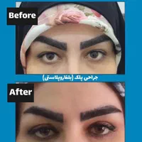 عمل جراحی پلک (بلفاروپلاستی)|خدمات آرایشگری و زیبایی|اصفهان, مسجد مصلی|دیوار