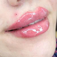 جوانسازی با تزریق ژل و بوتاکس