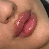 تخفیف ویژه مزو،آنزیم،ژل با بیحسی دندانپزشکی از ۴۰۰|خدمات آرایشگری و زیبایی|گرگان, |دیوار