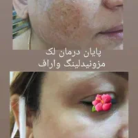 کوچک کردن بینی ورفع پف چشم بدون عمل جراحی|خدمات آرایشگری و زیبایی|مشهد, کوثر|دیوار