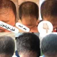 نانوکیت درمان ریزش مو و رویش مجدد|آرایشی، بهداشتی، درمانی|تهران, خرمشهر|دیوار