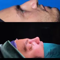 رینوپلاستی (بینی)فرصتی|خدمات آرایشگری و زیبایی|پاکدشت, |دیوار