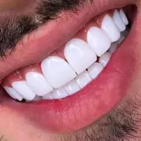 کلینیک زیبایی دندان « کامپوزیت و لمینیت اقساطی|خدمات آرایشگری و زیبایی|قم, باجک دو|دیوار