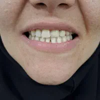 دندانپزشکی .دست دندان  هر فک ۴ میلیون تحویل ۳ روزه|خدمات آرایشگری و زیبایی|اسلام‌شهر, |دیوار