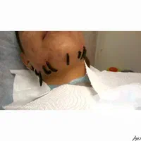 حجامت پاییز فصد لیزر غلظت کبد چرب افزایش قد ژل
