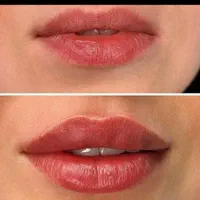 ژل و بوتاکس و لیفت نخ مزوتراپی و آنزیم.فیلربادی|خدمات آرایشگری و زیبایی|کرج, مهرویلا جنوبی|دیوار