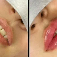 تزریق ژل لب صورت فیلر بوتاکس میکرونیلدینگ مزوتراپی|خدمات آرایشگری و زیبایی|شیراز, شهرک گلستان|دیوار