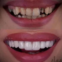 روکش دندان زیرکونیا مناسب|خدمات آرایشگری و زیبایی|تهران, افسریه|دیوار