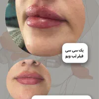 فیلر صورت و لب
