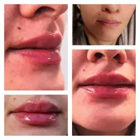 ژل لب، خط خنده، چانه، گونه، زاویه فک بوتاکس