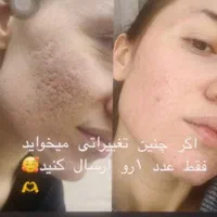 پلاسماجت.درمان نواقص پوستی.پلکسر پلک بینی و بوتاکس