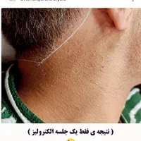 تخفیف الکترولیز،(×لیزر نیست) حذف دائم موهای زائد|خدمات آرایشگری و زیبایی|یاسوج, |دیوار