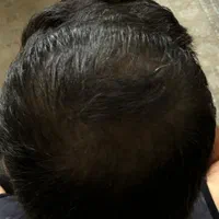 پرپشتی مو با روش اسکالپ/میکرواسکالپ در کلینیک پزشک|خدمات آرایشگری و زیبایی|مشهد, احمدآباد|دیوار