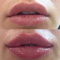 خدمات فیلر زیبایی ،فیشیال تخصصی ،هایفوتراپی|خدمات آرایشگری و زیبایی|زاهدان, |دیوار
