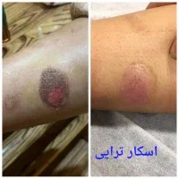 ترمیم زخم قطعی به شیوه نوین باقیمت ارزان|خدمات آرایشگری و زیبایی|اصفهان, سلطان‌آباد|دیوار