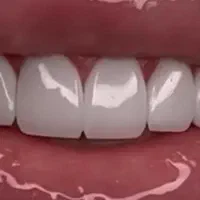 لمینت / دندون مصنوعی