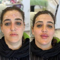 لیفت صورت با نخ. ژل.بوتاکس.مزوژل. درکلینیک|خدمات آرایشگری و زیبایی|کرمانشاه, |دیوار