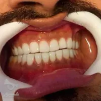 انجام خدمات زیبایی دندان با تخفیف ۶۵٪ از دست ندید