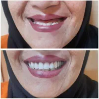 دندانسازی /دندان متحرک /دندان مصنوعی|خدمات آرایشگری و زیبایی|مشهد, حرم مطهر رضوی|دیوار