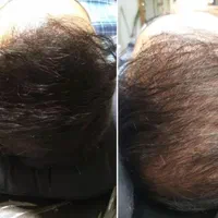 پرپشتی مو با روش اسکالپ/میکرواسکالپ در کلینیک پزشک|خدمات آرایشگری و زیبایی|مشهد, احمدآباد|دیوار