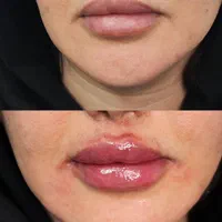 تزریق ژل وبوتاکس و لیزر موی زایدولیزر پاک کردن تتو|خدمات آرایشگری و زیبایی|نسیم‌شهر, |دیوار