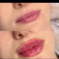 تزریق ژل وبوتاکس