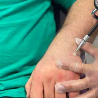 درمان زگیل تناسلی/لیزر/کرایو فریز/hpv/توسط پزشک|خدمات آرایشگری و زیبایی|اهواز, کیانپارس |دیوار