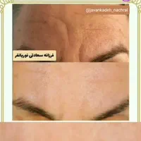 چین و چروک|آرایشی، بهداشتی، درمانی|تهران, جابری|دیوار