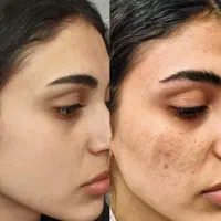 تزریق ژل و بوتاکس و آنزیم بینی،برداشتن خال و تتو