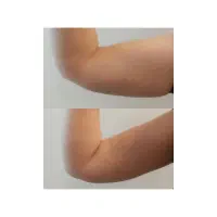 لیزر لاغری صدرد تضمینی بدون بازگشت