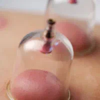 حجامت درمانی در مطب زیر نظر پزشک
