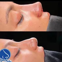 جراحی زیبایی بینی فقط با 19 میلیون