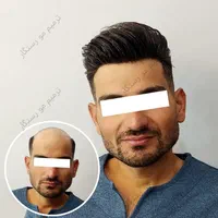 ترمیم مو /پروتز مو / جایگزین کاشت مو و کلاهگیس
