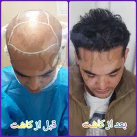 کاشت مو و ابرو بدون سوزن و درد در تهران