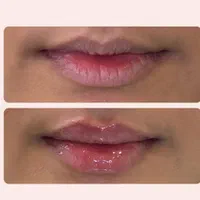 فیلر،بوتاکس،مزوتراپی،عصاره سلول بنیادی توسط پزشک|خدمات آرایشگری و زیبایی|زاهدان, |دیوار