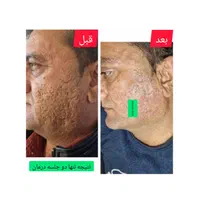 درمان تضمینی وماندگار تو رفتگی پوستی/جای جوش/اسکار|خدمات آرایشگری و زیبایی|اصفهان, باغ دریاچه|دیوار