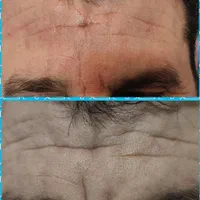 فیلر پیشانی و خط اخم / رفع چین عمیق / دکتر میثم|خدمات آرایشگری و زیبایی|شوش, |دیوار