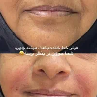 تزریق و آموزش انواع فیلرو بوتاکس|خدمات آرایشگری و زیبایی|مشهد, فرهنگیان (شهرک غرب)|دیوار