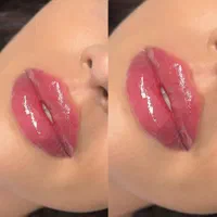 ژل بوتاکس فیلر مزو نخ کانتورینگ‌ درکلینیک زیبایی