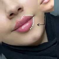 مطب تخفیف ژل و فیلر لب و صورت و بوتاکس|خدمات آرایشگری و زیبایی|قم, صفائیه|دیوار