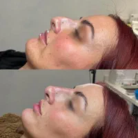 ژل لب/گونه/بوتاکس/فیلربینی/مزوپی ار پی|خدمات آرایشگری و زیبایی|مشهد, سجاد شهر|دیوار