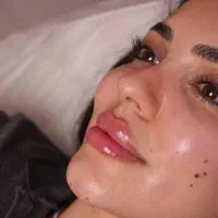 جشنوراه اقساطی ژل و بوتاکس با ضمانت بی قید و شرط