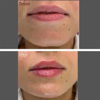 تزریق ژل و فیلر و بوتاکس و نخ لیفت و پی آرپی و ...|خدمات آرایشگری و زیبایی|همدان, |دیوار