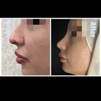 جراحی رینوپلاستی۲۷زیبایی بینی|خدمات آرایشگری و زیبایی|قم, بلوار امین و ساحلی|دیوار