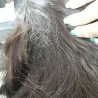 رفع تضمینی شپش و رشک بدون بازگشت بدون دوره درمان|خدمات آرایشگری و زیبایی|قم, نیروگاه|دیوار