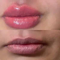 جشنواره زیبایی ژل بوتاکس هایفو جوانسازی پوست|خدمات آرایشگری و زیبایی|مشهد, گلبرگ شمالی|دیوار